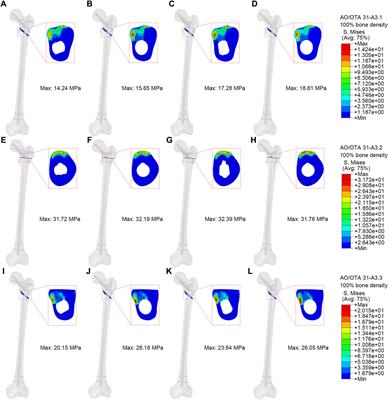 Comparative study of a novel proximal femoral bionic nail and three conventional cephalomedullary nails for reverse obliquity intertrochanteric fractures: a finite element analysis